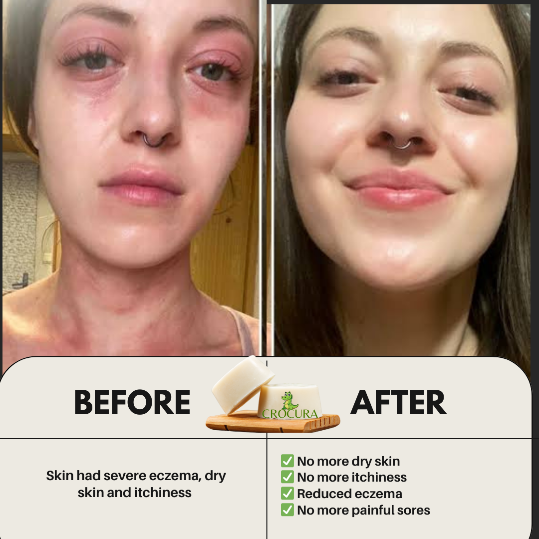 Crocura Soothing Soap